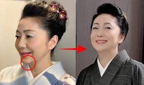 ほくろ除去の噂が広まったきっかけ